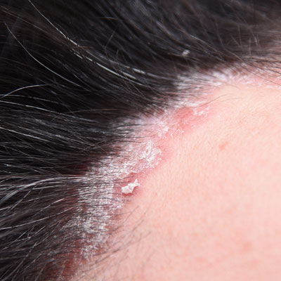 Foto van psoriasis aan de haargrens